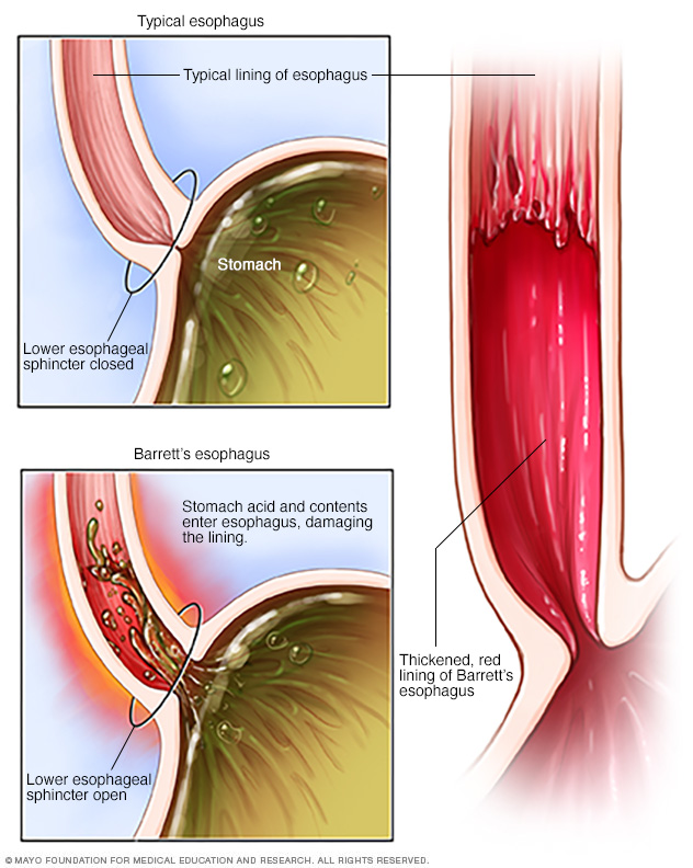 Barrett's esophagus - Mayo Clinic