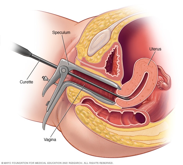 How D&C procedure is done