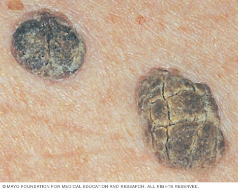 seborrheic keratosis)