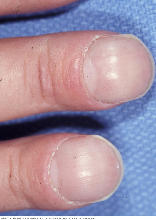 Genes | Free Full-Text | Homozygous Missense Variant in the Solute Carrier  Organic Anion Transporter 2A1 (SLCO2A1) Gene Underlies Isolated Nail  Clubbing