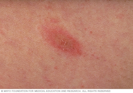 Photograph showing herald patch of pityriasis rosea 
