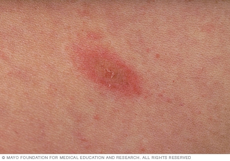 Pityriasis Rosea Symptoms And Causes Mayo Clinic