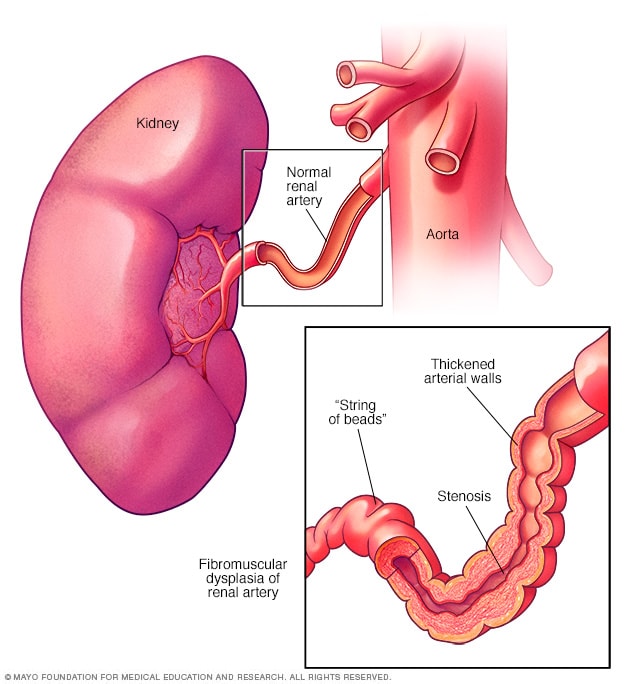 Displasia fibromuscular