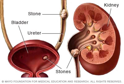 Képtalálat a következőre: „Kidney stones”