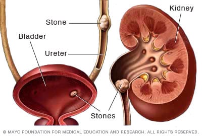 case study of kidney stone