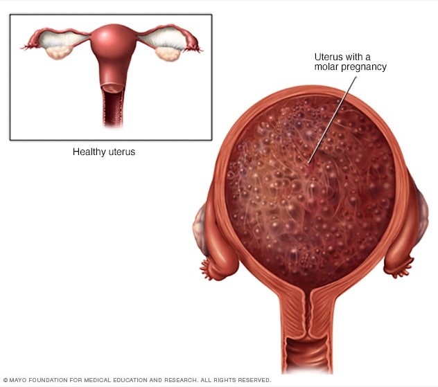 Illustration showing a molar pregnancy 
