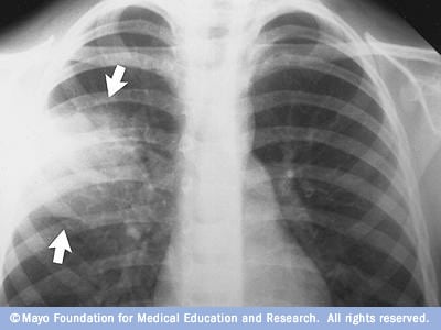 Imagen radiogrÃ¡fica de pulmones con neumonÃ­a