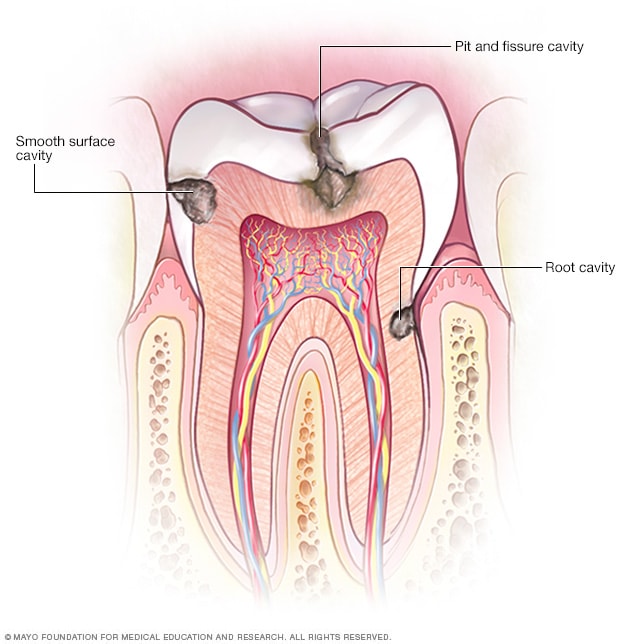 Cavities/tooth decay - Symptoms and causes - Mayo Clinic