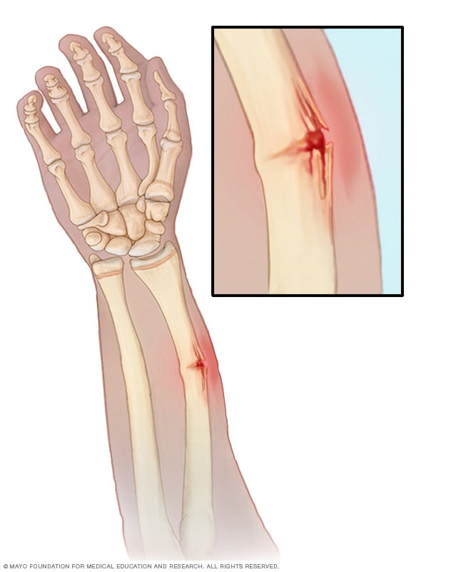 Greenstick fractures - Symptoms and causes - Mayo Clinic