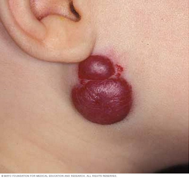 Hemangioma Symptoms And Causes Mayo Clinic