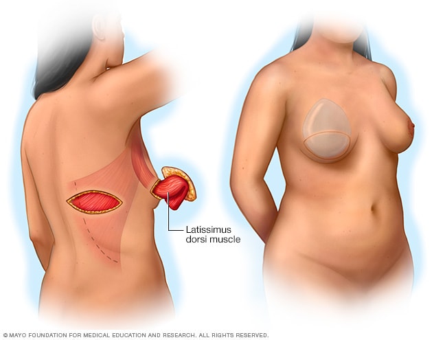 After double breast mastectomy reconstruction Mammograms After