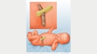 Cordón umbilical en el nacimiento 