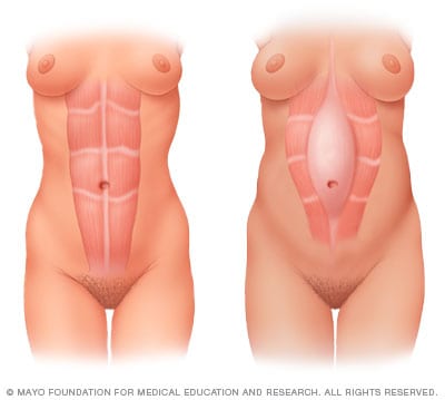 Separación de los músculos abdominales durante el embarazo 