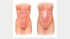 فصل عضلات البطن أثناء الحمل 