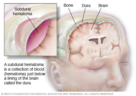 Illustration showing intracranial hematoma