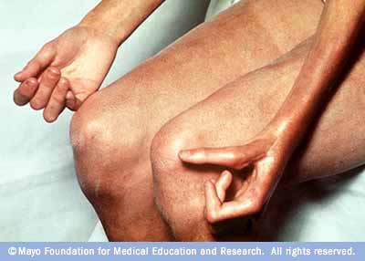 Photograph of the hands and legs of a person with scleroderma 

