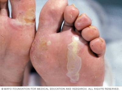 La epidermólisis bullosa simple afecta principalmente a las palmas de las manos y a los pies.