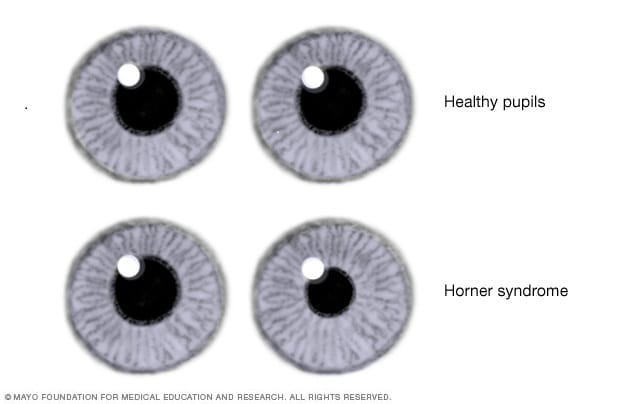 Horner Syndrome - Symptoms And Causes - Mayo Clinic