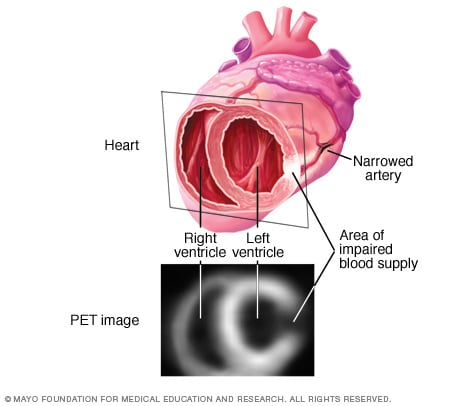Imagen de tomografía por emisión de positrones del corazón 