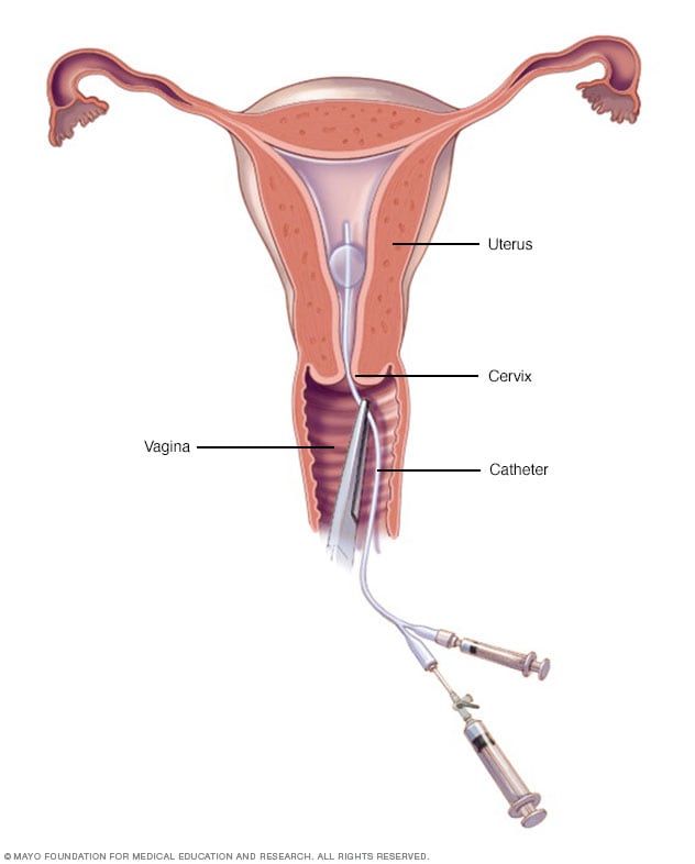 Hysterosalpingography