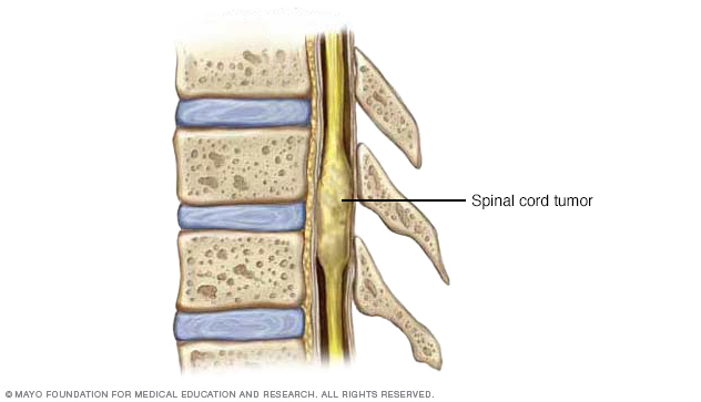 tumor on spine symptoms