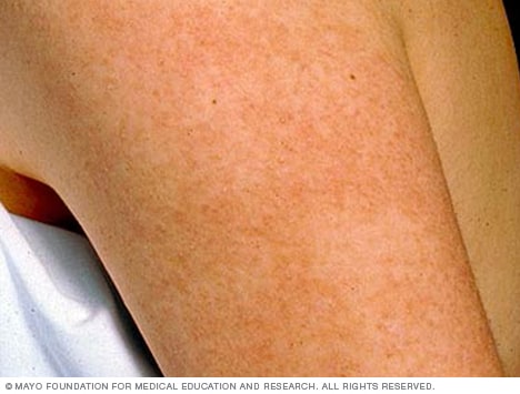 Queratosis pilaris en un brazo