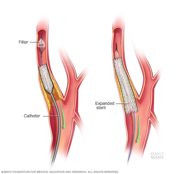 Colocación de un stent en la carótida
