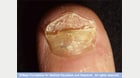 Photo of an infected nail
