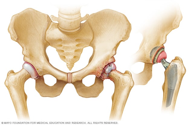 hip replacement artificial joint surgery osteoarthritis after ball mayo before socket clinic mayoclinic