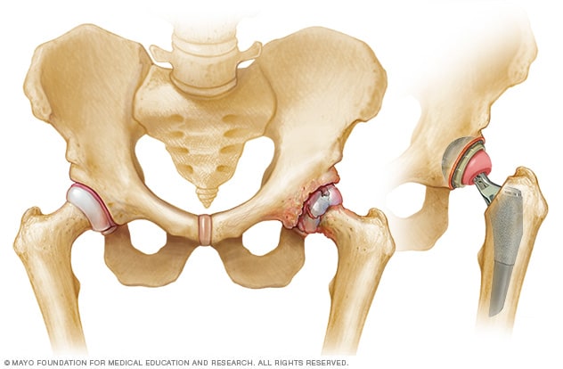 A térdízület 3. fokú deformáló artrózisa