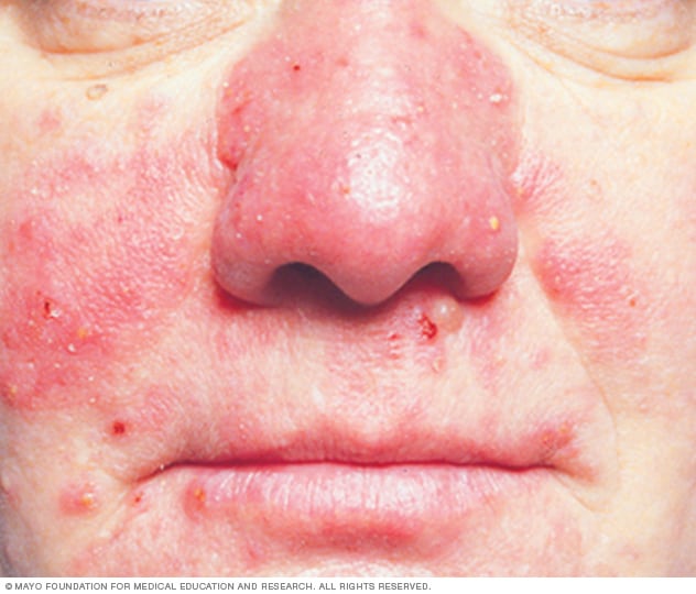 Rosacea Symptoms and causes - Mayo