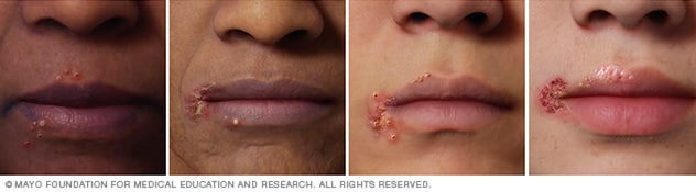 Cold sore on four different skin colors.