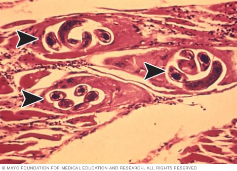 Microscopic view of trichinella cysts in muscle tissue