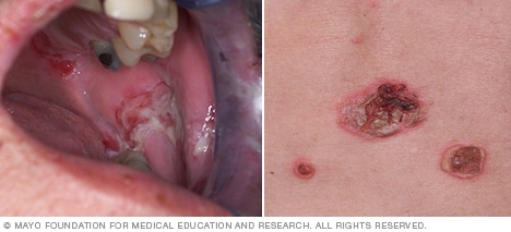 الفقاع الشائع في الفم والجلد 