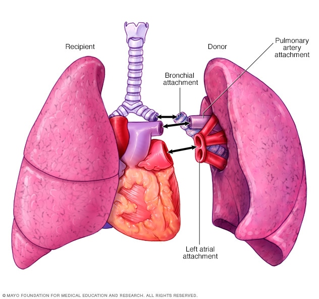 Lung transplant