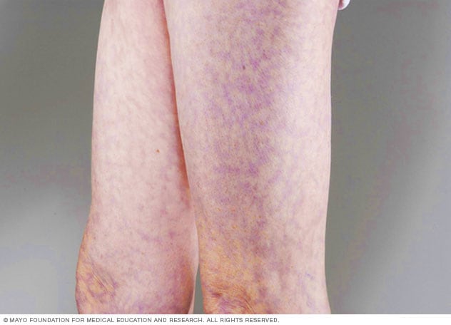 Livedo reticularis deals