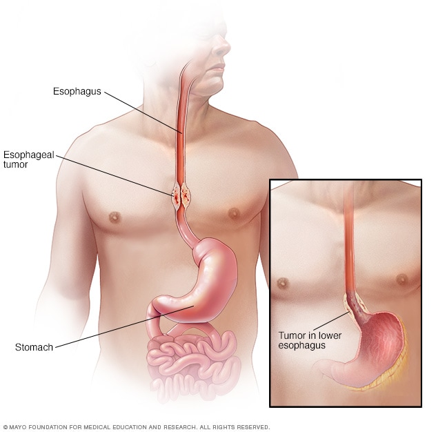 Medical illustration of esophageal cancer