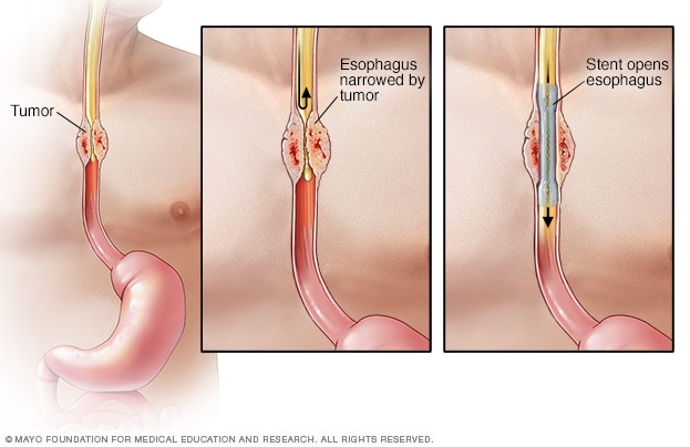 Stent esofágico