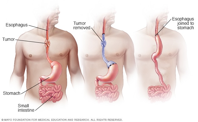 Cirugía para el cáncer de esófago