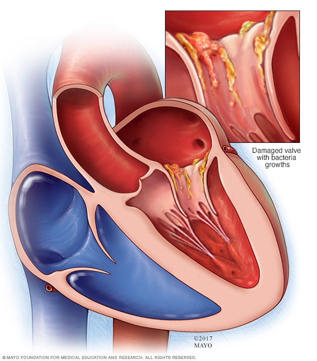 Efectos de la endocarditis en el corazón