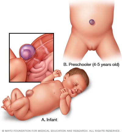 Hernia umbilical