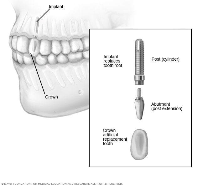 Dental implant surgery Mayo Clinic