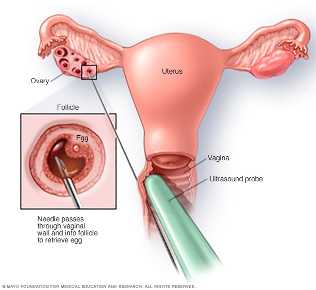 Transvaginal ultrasound