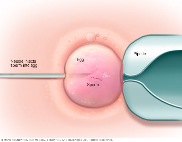 The abbreviation IVF is laid out in wooden letters on a blue background. In  vitro injection