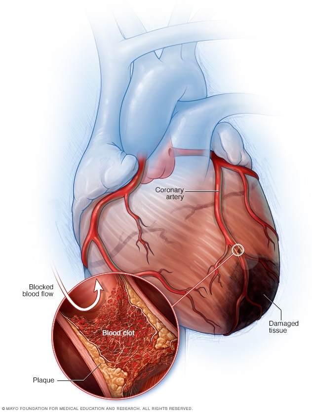 Ilustración que muestra arterias bloqueadas y tejido dañado en un ataque al corazón.
