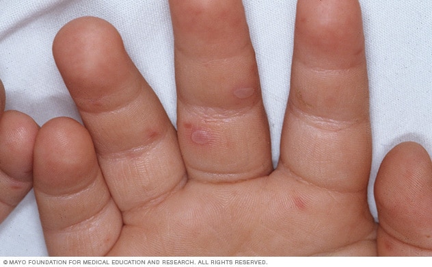 Rash on the hand caused by hand-foot-and-mouth disease