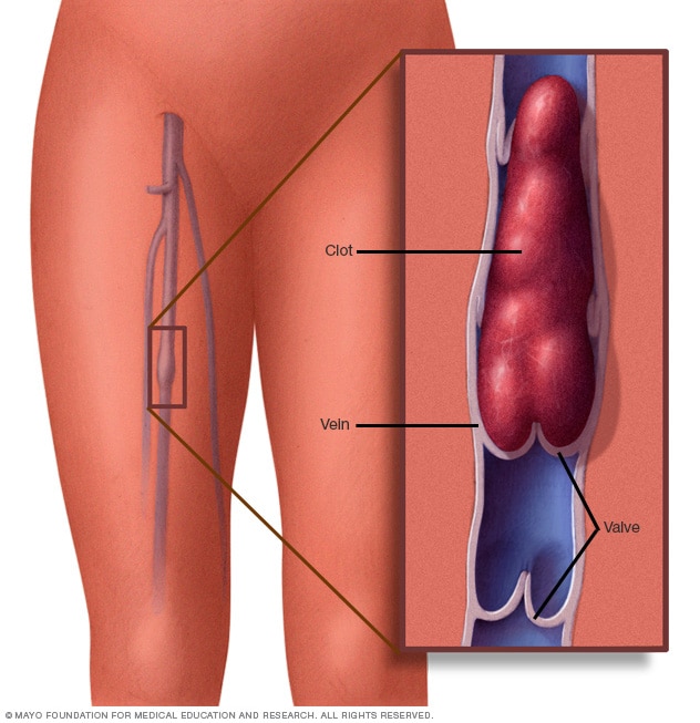 التهاب الوريد الخثاري الأعراض والأسباب Mayo Clinic مايو كلينك