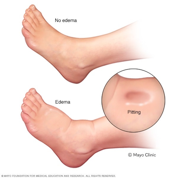 Edema in foot and ankle