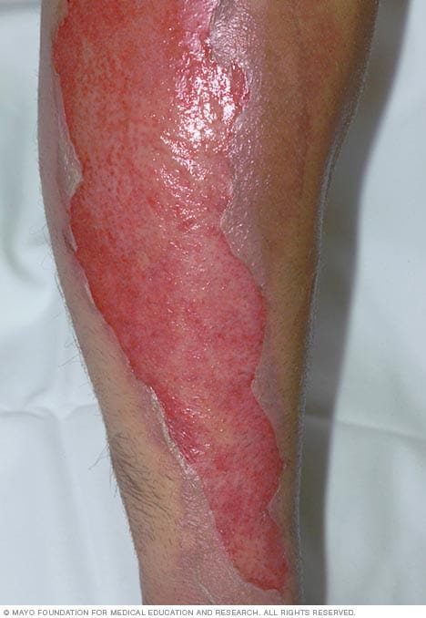 Burns - Symptoms and causes - Mayo Clinic