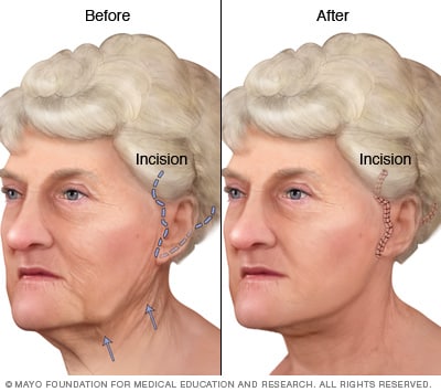 Face-lift - Mayo Clinic